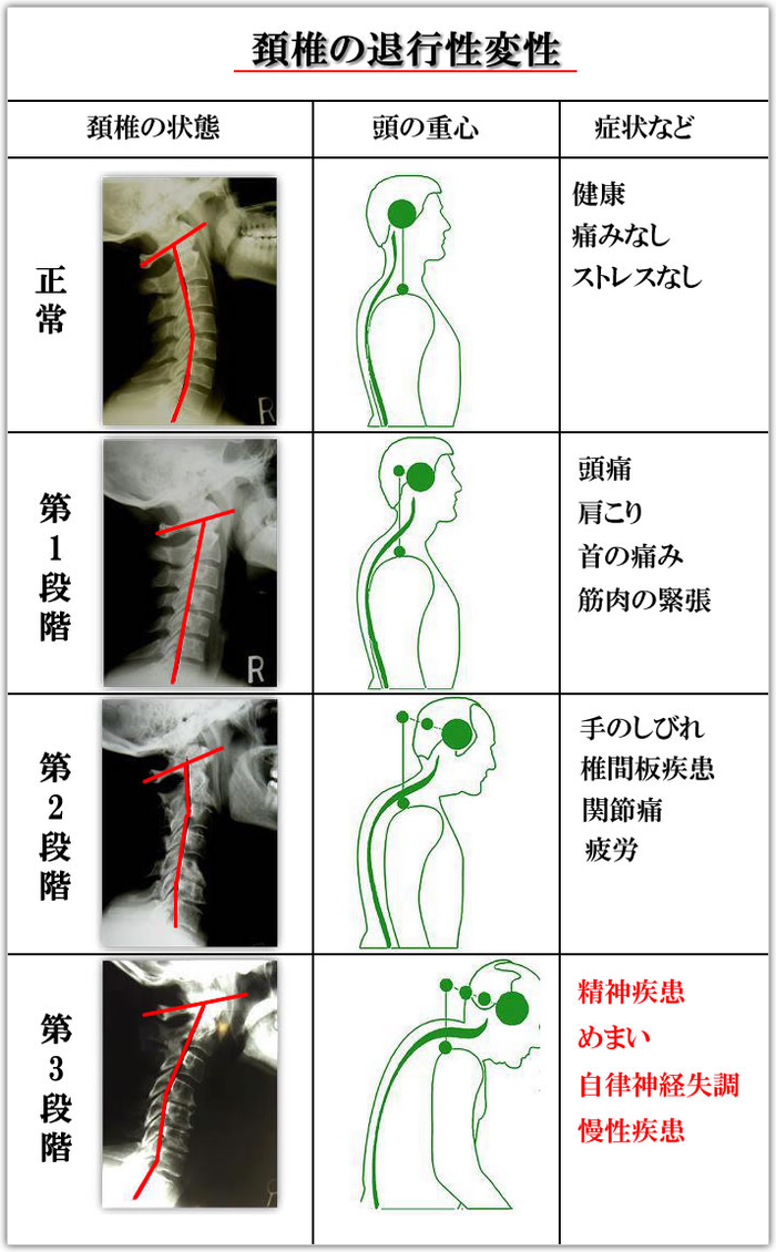 交通事故治療、むち打ち症、川崎、横浜、頚椎の退行性変性
