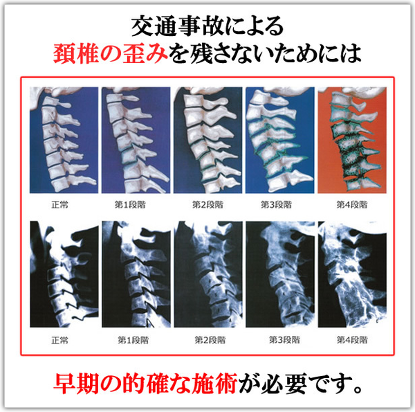 川崎交通事故治療　むち打ち後遺症